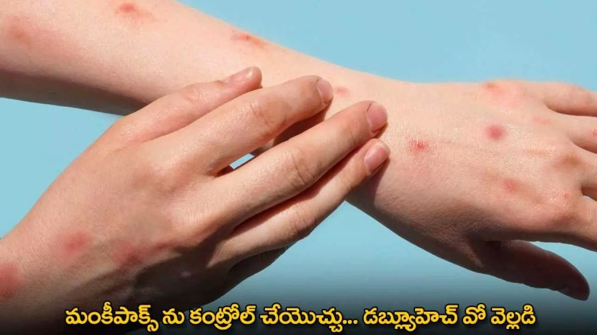 MPOX : మంకీపాక్స్ ను కంట్రోల్ చేయొచ్చు... డబ్ల్యూహెచ్ వో వెల్లడి